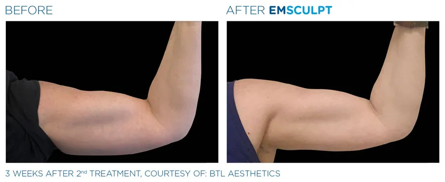 Emsculpt Neo Arms Treatment | Body Contouring Boston