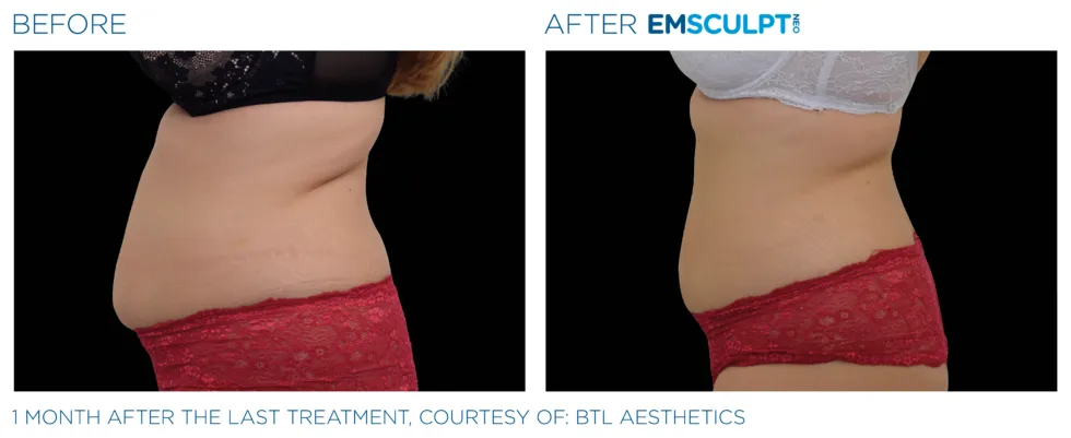 Emsculpt Neo Torso Treatment Acton