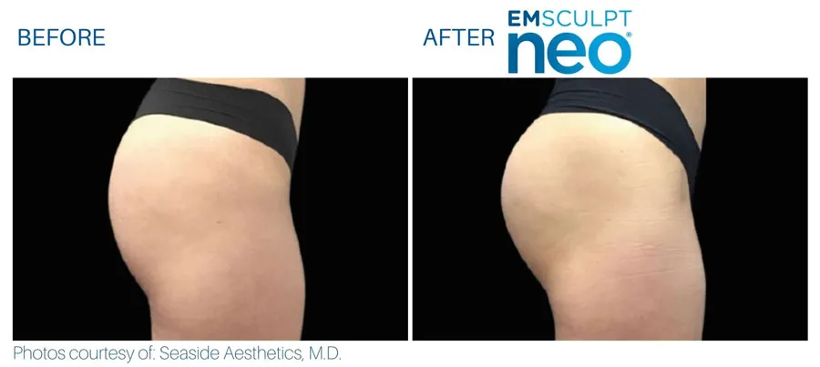 Emsculpt Neo Hips and Thighs Treatment Acton