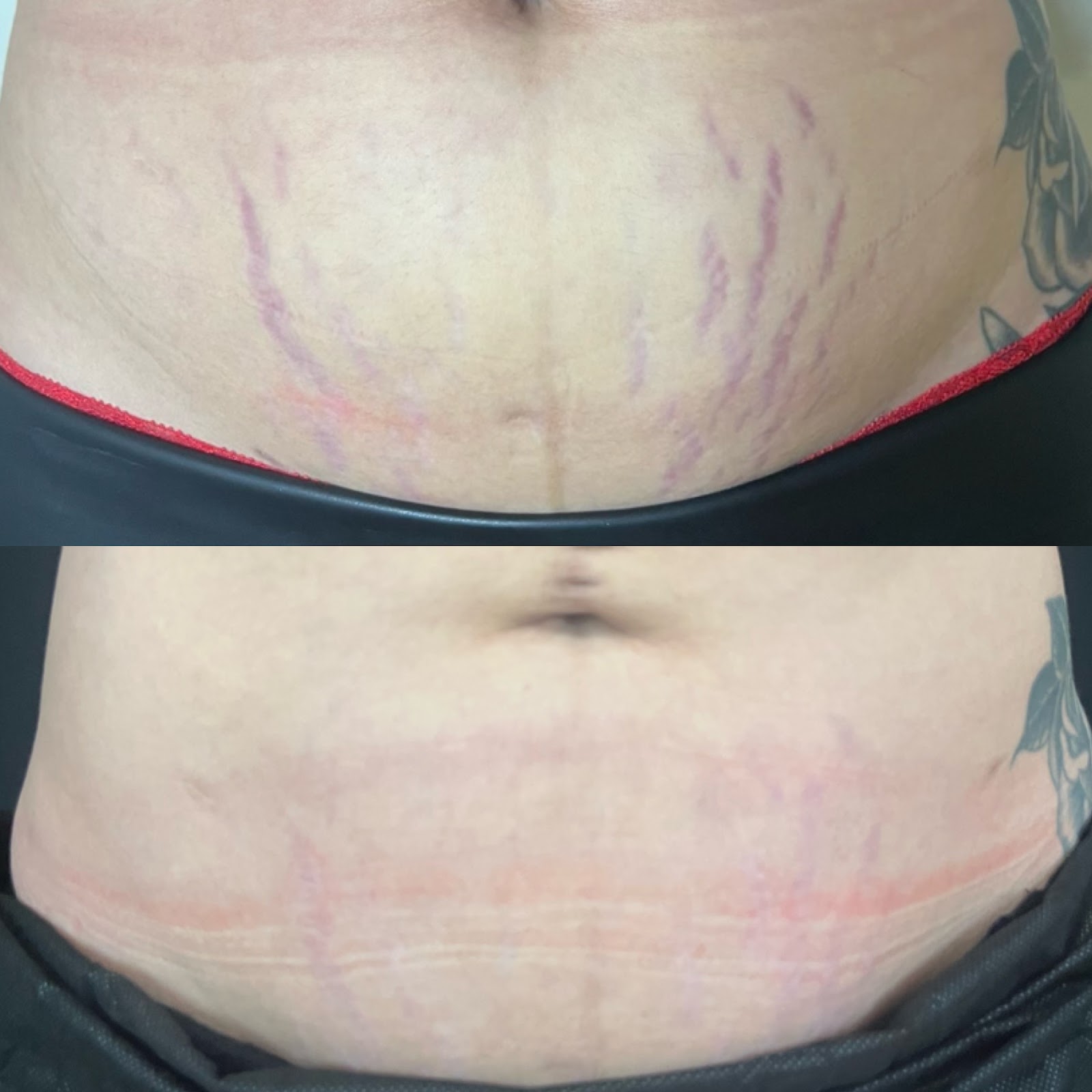 Morpheus8 · Stretch Mark Removal before and after