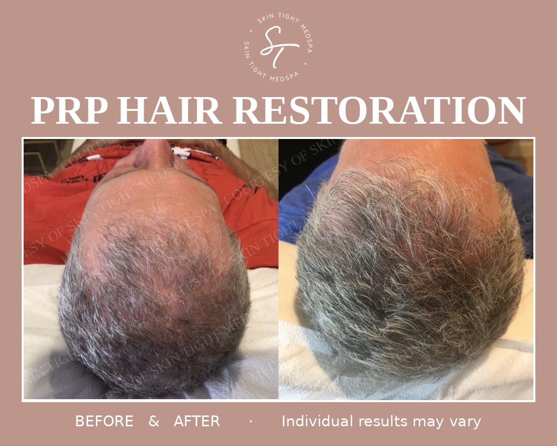 PRP · Hair Restoration before and after